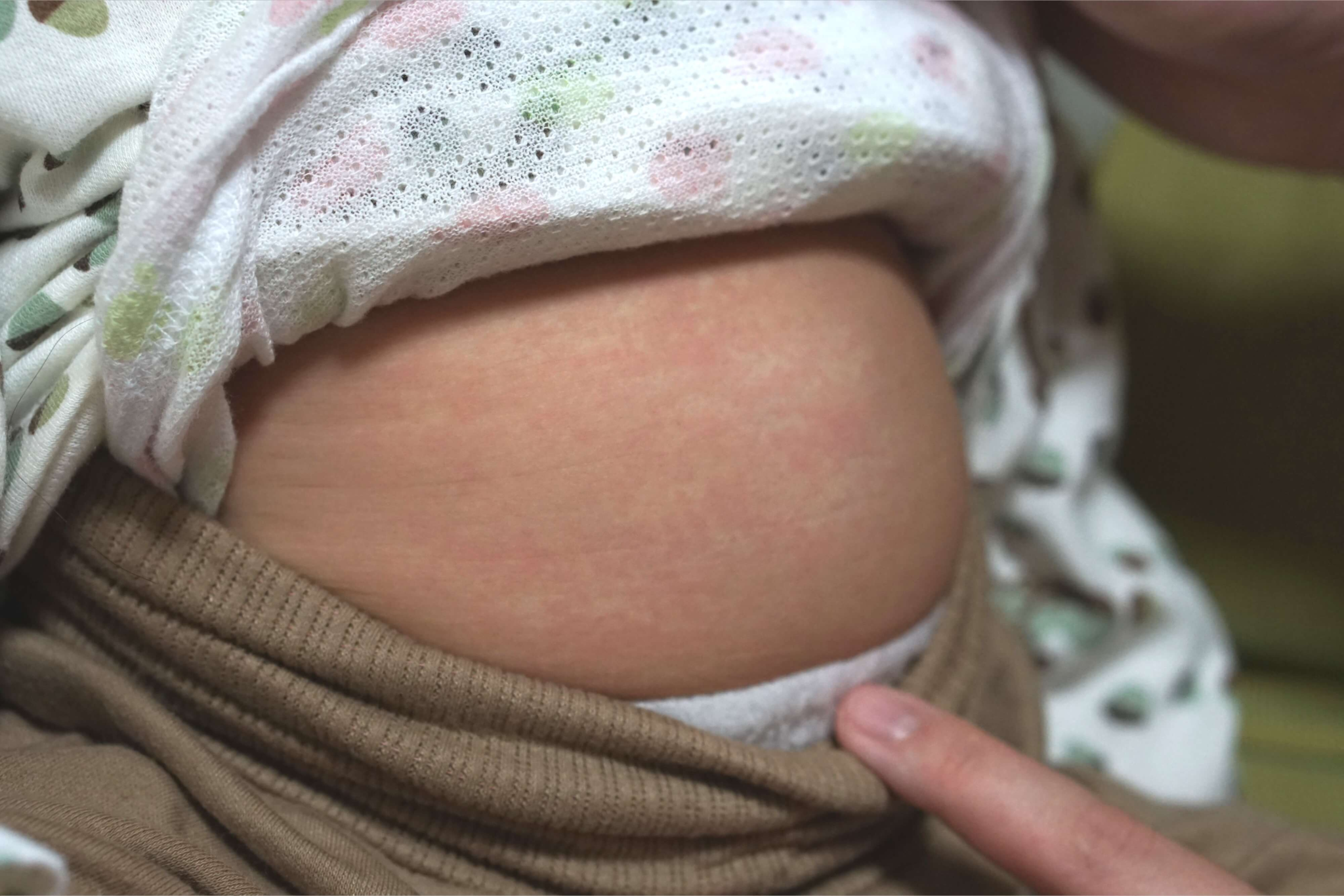 コルチコステロイドクリーム